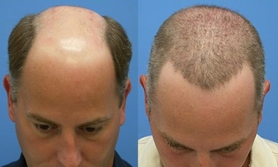 +90 532 5482489 Kulis Estetik Hair Transplant - Saç Ekimi