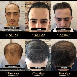 Ahmet Tosun Saç Ekimi (The Hair Clinicc)