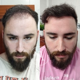 Aisha Hair | Injerto Capilar Turquía | Hair Transplant Turkey