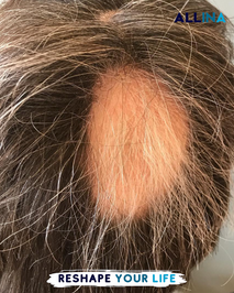 Allina Hair Clinic / Saç Ekimi ve Saç Sorunları Merkezi