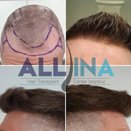 Allina Hair / Saç Ekimi ve Saç Sağlığı