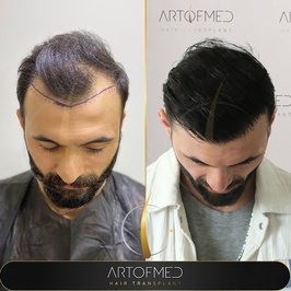 Art of Med Clinic - Saç Ekimi & Hair Transplant