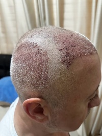 Arz Hair Center Saç Ekim Merkezi