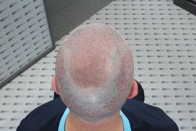 Asmed Hair Transplant Clinic - Istanbul Turkey