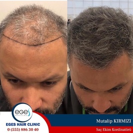 Aydın Saç Ekim Merkezi Eges Hair Clinic