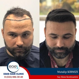 Aydın Saç Ekim Merkezi Eges Hair Transplant Clinic