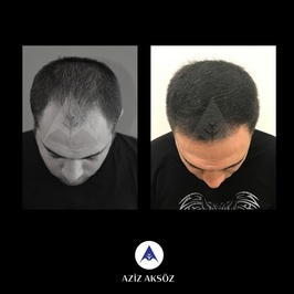 Aziz Aksöz - Hair Transplant Turkey,Hair Transplant İstanbul