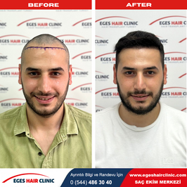 Bayraklı Saç Ekim Merkezi - İzmir Eges Hair Transplant