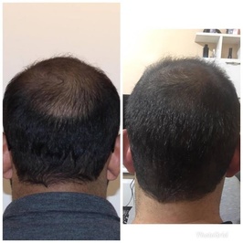 Capillum Clinic Saç Ekimi ve Saç Sağlığı Merkezi