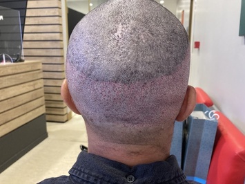 Cosmedica Hair Transplant Clinic | Dr. Levent Acar