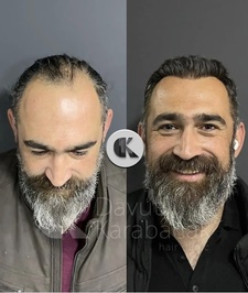 Davut Karabacak Saç Ekim Merkezi