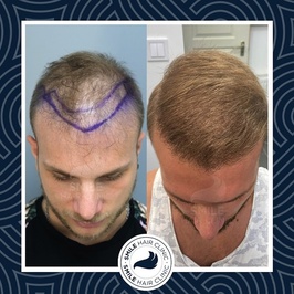 Dr. Gökay Bilgin & Dr. Mehmet Erdoğan Saç Ekim Kliniği