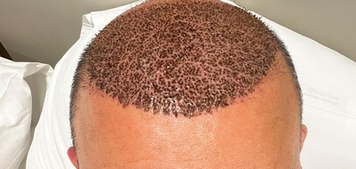 Dr Serkan Aygın Hair Transplant Clinic - Istanbul Turkey