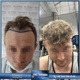Dr. Ziya Yavuz Clinic | Hair Transplant Turkey , Istanbul