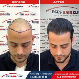 Eges Hair Clinic | İzmir Saç Ekim Merkezi