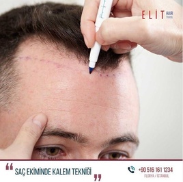 Elit İstanbul Hair Transplant