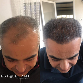 Estelegant | Bircan Saydam | Saç Ekimi