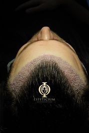 Esteticium Hair Transplant