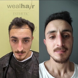Esteweal Hair Clinic Saç Ekimi