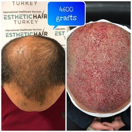 Esthetic Hair Turkey