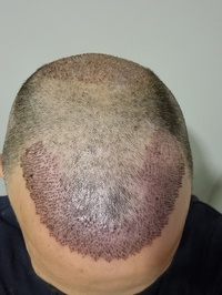 Fatma Dursun Hair Transplant