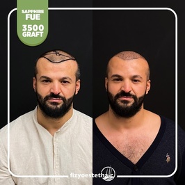 Fizyoestet Hair - Hair Transplant in Turkey