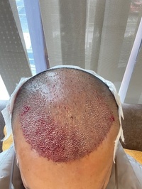 Hair Center of Turkey - Saç Ekimi