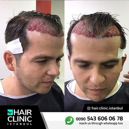 Hair Clinic Istanbul