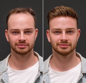 Hair Glow İzmit Protez Saç 24 Yıllık Tecrübesiyle Hizmetinizde.