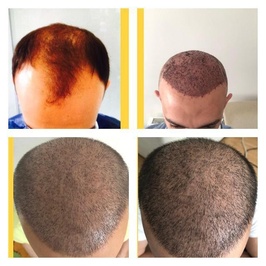 Hair Transplant Turkey