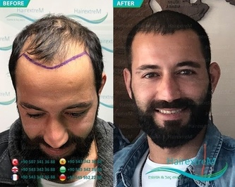 HairextreM & Haydar Aslan Saç Ekimi