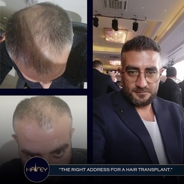 Hairey Saç Ekim Merkezi