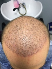 Hairnorm
