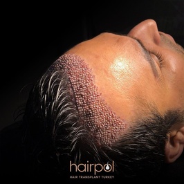 Hairpol (Saç Ekimi Kliniği)