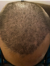 Hermest Hair Transplant