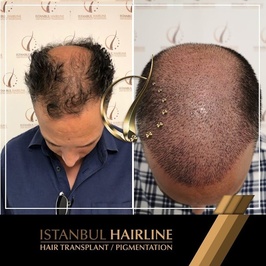 İstanbul Hairline Saç Ekimi Merkezi