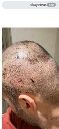 İsveç Klinik - Saç Ekimi & Estetik Cerrahi Merkezi