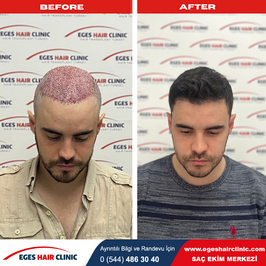 İzmir Hair Transplantation İzmir Saç Ekimi Eges Hair Transplant