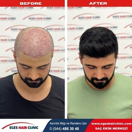Kuşadası Saç Ekim Kliniği