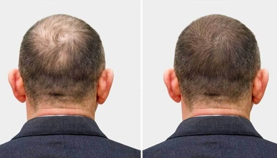 Lupi Hair Transplantation Clinic