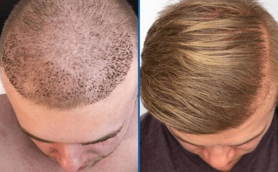 MAGIC TOUCH HAIR RESTORATION TRANSPLANT