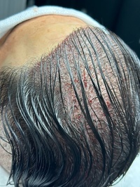 Maxhairclinic saç ekim İzmir