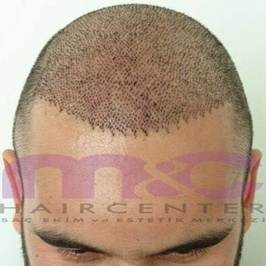 MC Hair Center Saç Ekim & Estetik Merkezi