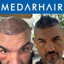 MEDAR Sakarya Saç Ekimi MEDARHAIR
