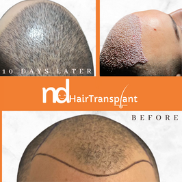 ND Hair Transplant