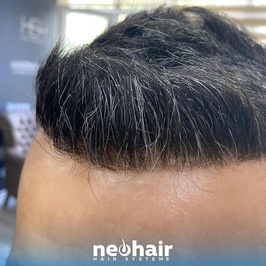 NeoHair Protez Saç Merkezi