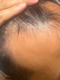 Now Hair Time Hair Transplant in Turkey