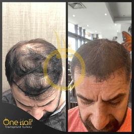 One Hair Clinic Transplantation - Plastic Esthetic