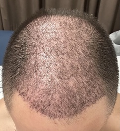 Ozel Hair Transplant