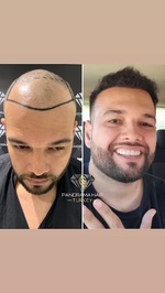 Panorama Hair Turkey